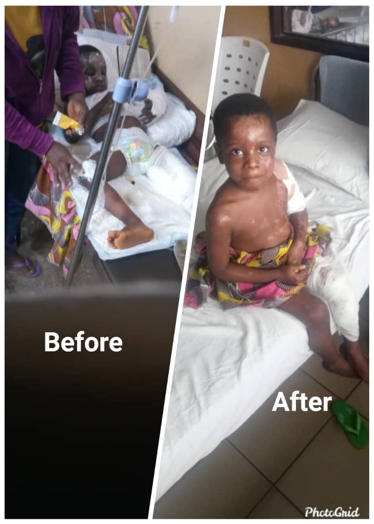 FIRE ACCIDENT SURVIVOR