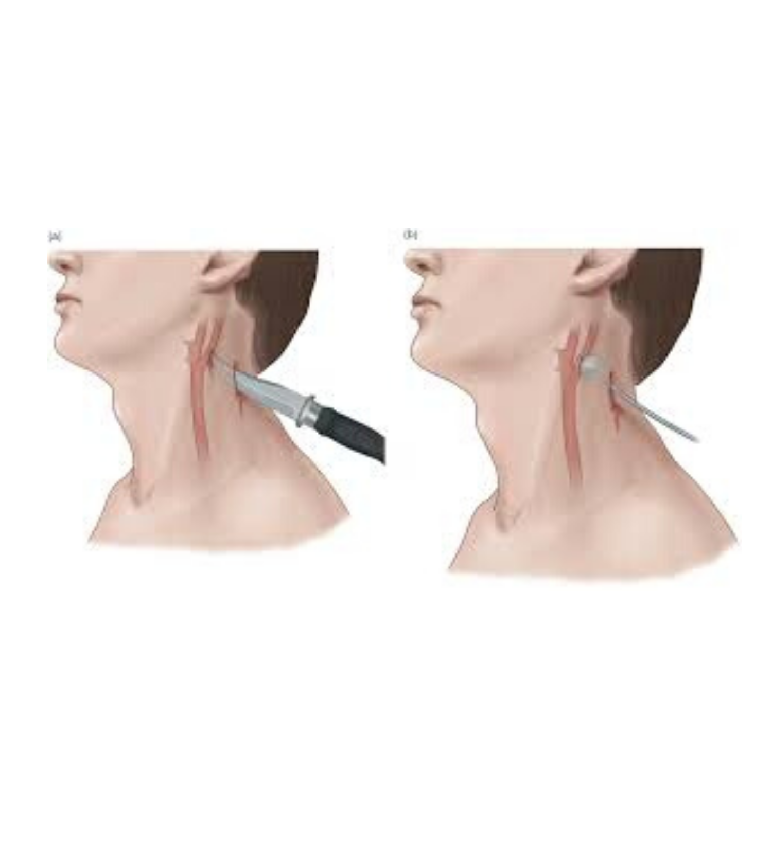 NECK TRAUMA: The penetrating pain